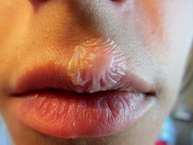 L'applicazione dei cerotti