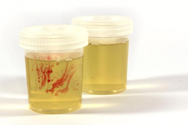 Sangue nelle urine