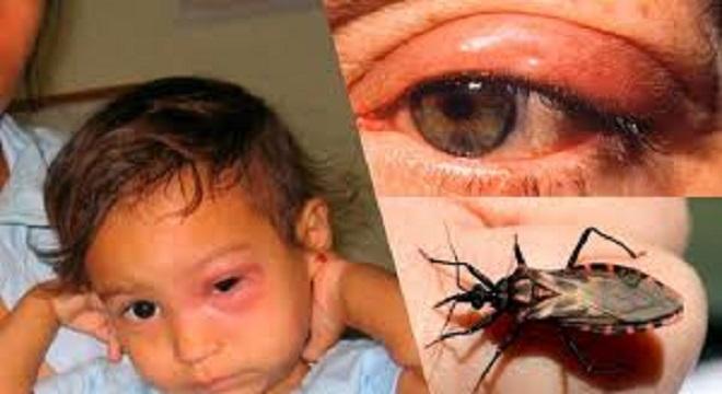 Tripanosomiasis americana