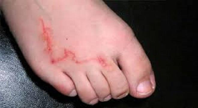 Larva migrans cut&aacute;nea