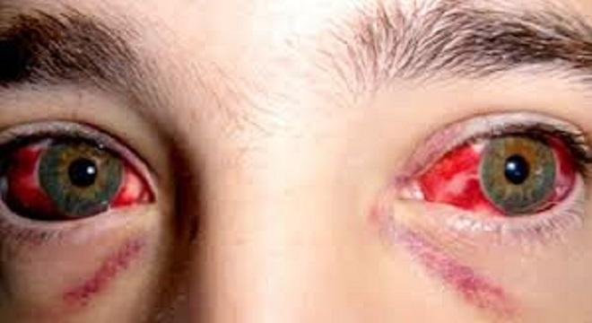 Fiebres hemorr&aacute;gicas por Arenavirus