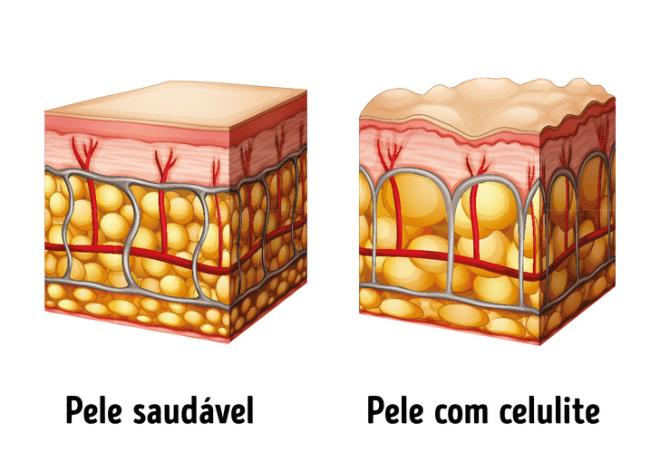 "As toxinas causam a celulite"
