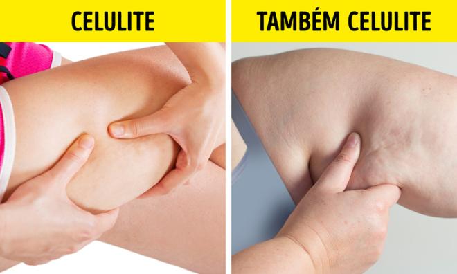 "A celulite surge apenas abaixo da cintura"