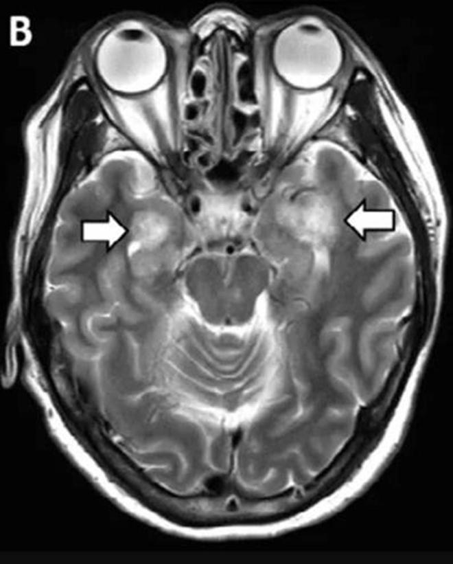 Pacientes con ACV y convulsiones
