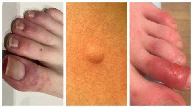 Manifestaciones cut&aacute;neas