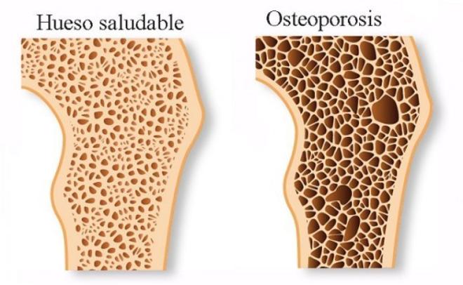 Osteoporosis