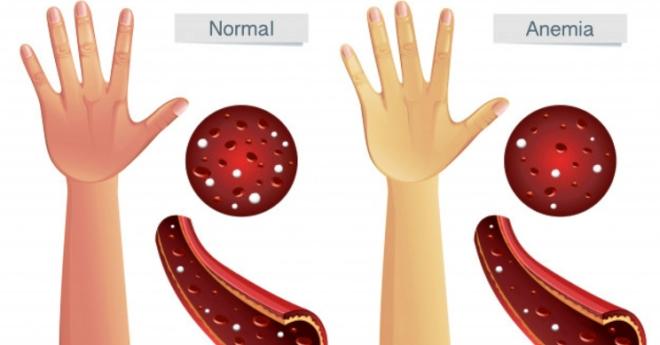 Anemia, m&aacute;s hierro y vitamina C