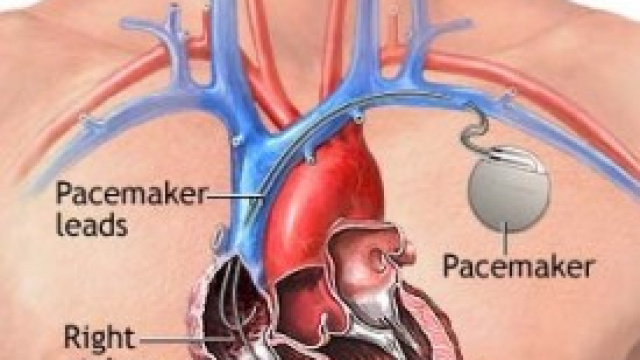 il nuovo impianto wireless di peacemaker.