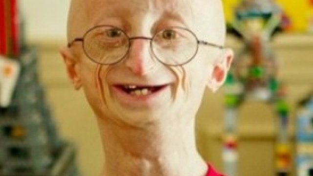 Sam Bern morto, ragazzo malato di progeria.