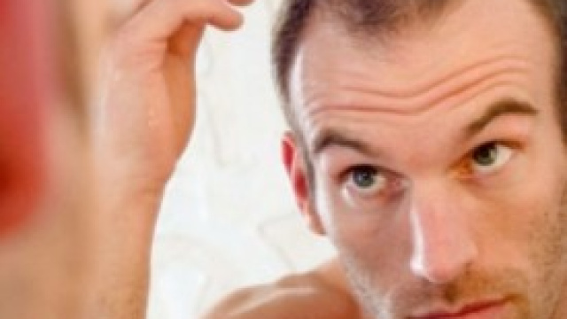 Autotrapianto capelli, limiti e benefici