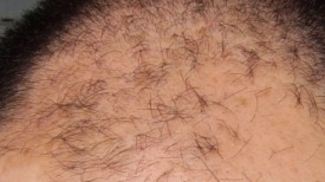 rimedi diradamento dei capelli