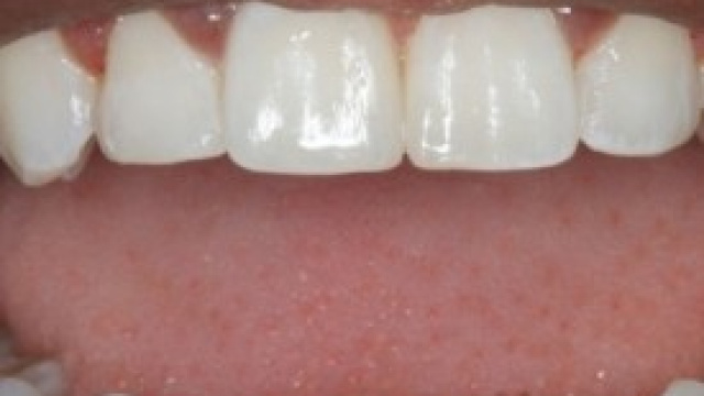 Dente del giudizio: come alleviare il dolore