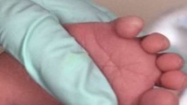 Muore uno dei due gemelli di Alessandria.