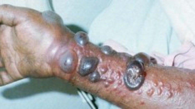 L'ebola arriva negli Usa, il primo contaggio