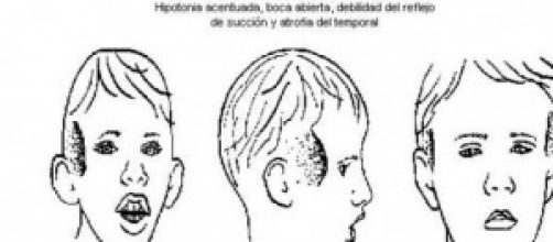 Descripci&oacute;n gr&aacute;fica de la distrofia muscular