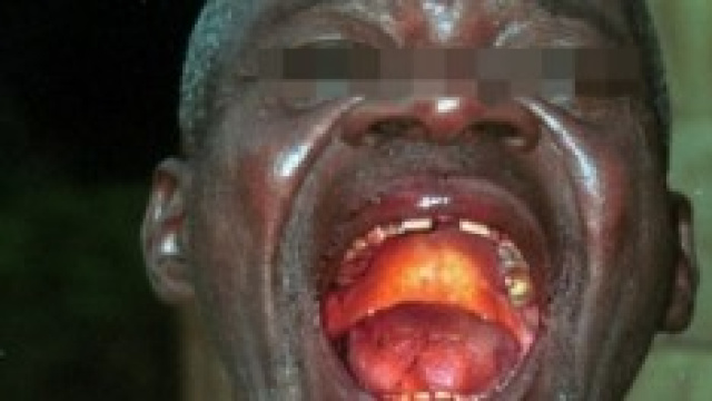 Rischio per l'Europa al contagio con l'epidemia