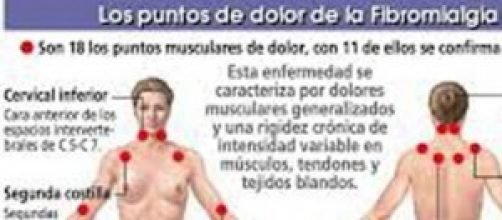 El mapa del dolor de la fibromialgia