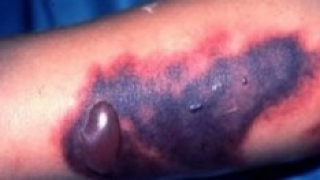 Virus Ebola: com'&egrave; la situazione in Italia?