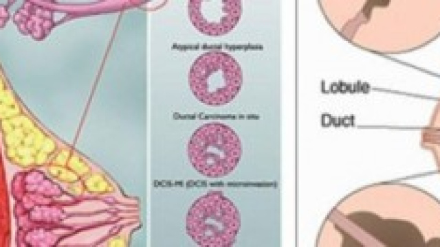 Immagine sul cancro al seno.