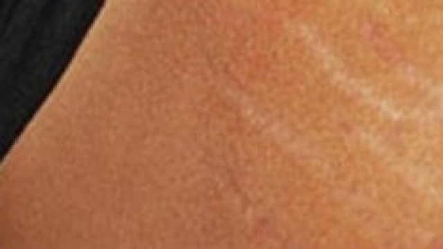 Rimedi efficaci per attenuare le smagliature 