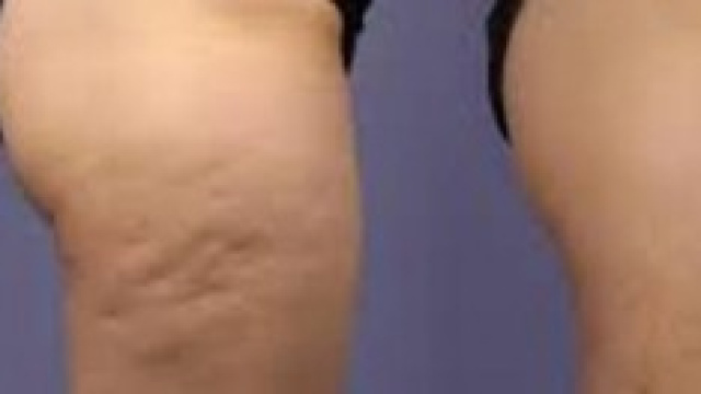 Sconfiggere la cellulite si pu&ograve;.