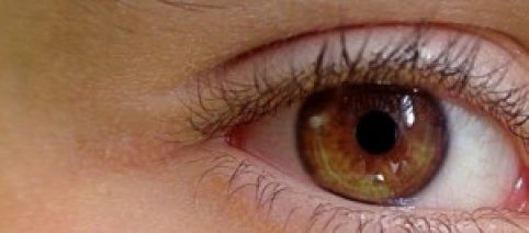 Microftalmia e Anoftalmia: tudo sobre a perda visual congênita