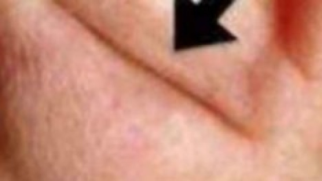 L'orecchio con la piega indice di rischi cardiaci