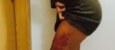 Andressa Urach aplicou 400 ml de hidrogel nas coxas. A quantidade indicada é de até 3 ml