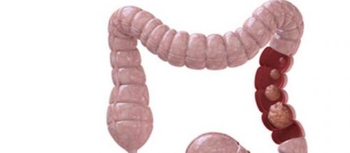 Los s&iacute;ntomas se manifiestan en enfermedad avanzada