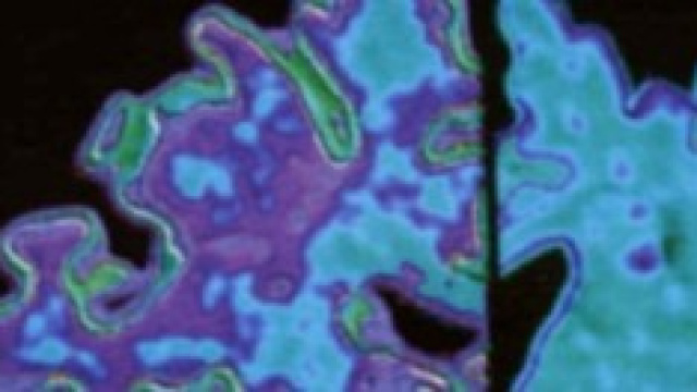 Alzheimer nuovo test per prevenirlo