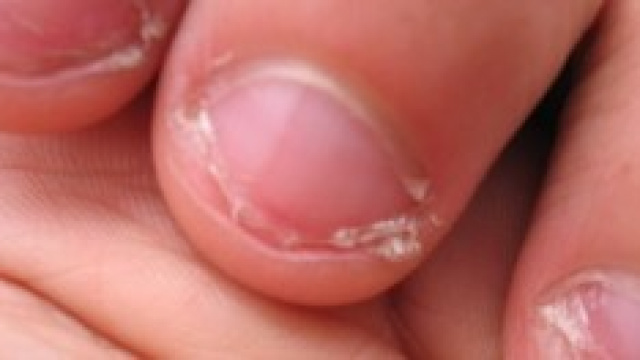 40enne muore perch&eacute; si mangiava le unghie