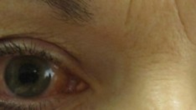 Anche i presbiti possono dire addio agli occhiali