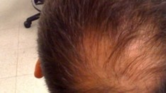 La rigenerazione cellulare contro l'alopecia