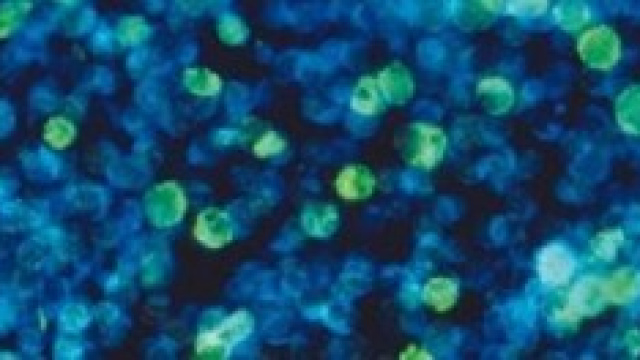 Mononucleosi: sintomi e cure