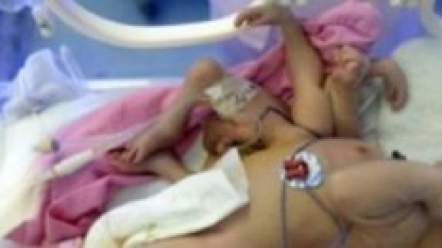 Operato in Cina il bimbo con 8 arti