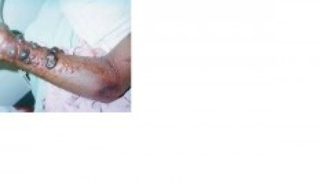 vittima contagio virus ebola