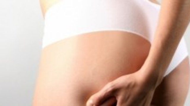 Cellulite, presente in nove donne su dieci