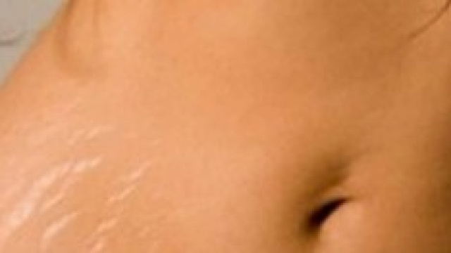 Smagliature 'bianche', sono le pi&ugrave; antiche