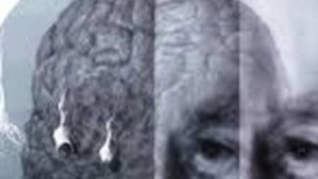 Diagnosi dell'Alzheimer  