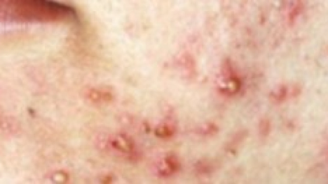 Un viso pieno di brufoli di un giovane