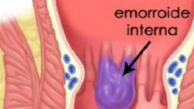 Emorroidi: cause, sintomi e cure