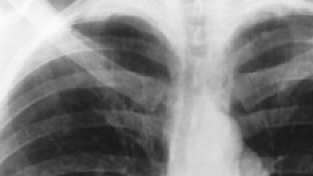 Una radiografia dei polmoni