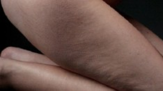 Eliminare la cellulite con cure naturali