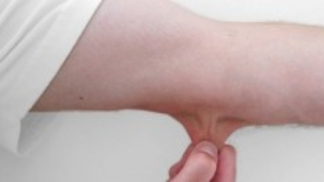 Prevenire tumori alla pelle: 5 regole del medico