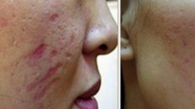 I risultati di un trattamento con il needling