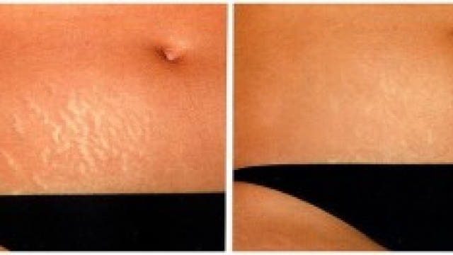 Smagliature: che guaio! Rimedi naturali.