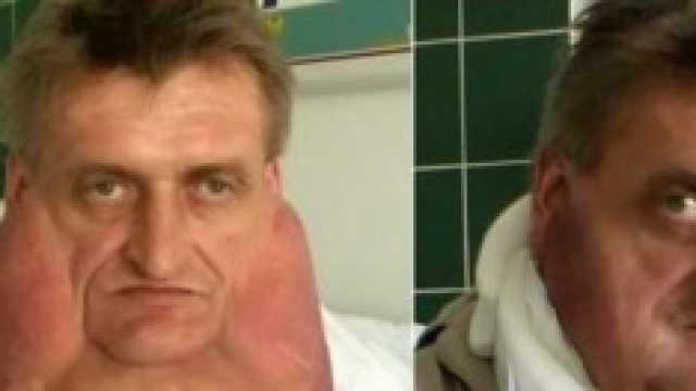 Tumore di 10 chili sul viso