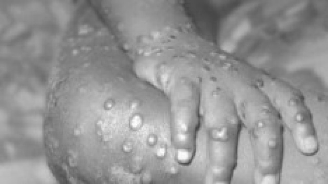 Eruzioni cutanee causate dal virus del vaiolo