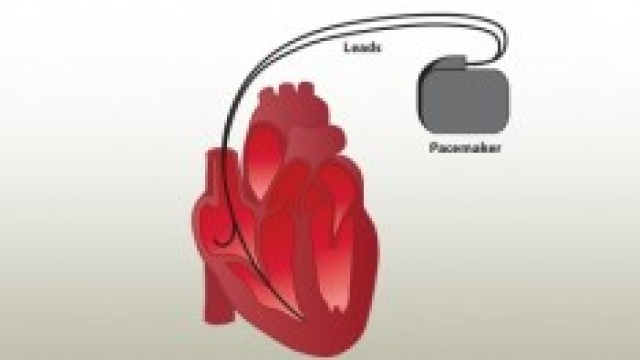immagine di un pacemacker attuale
