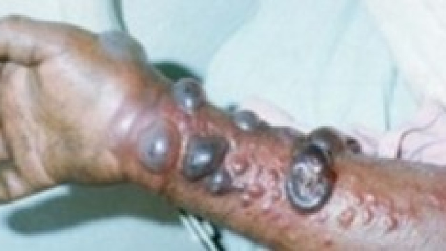 Sull'Ebola scatta l'allarme dell'Oms.